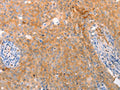 The image on the left is immunohistochemistry of paraffin-embedded Human cervical cancer tissue using CSB-PA949432(ABCA2 Antibody) at dilution 1/25, on the right is treated with synthetic peptide. (Original magnification: ×200)
