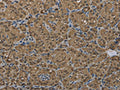 The image on the left is immunohistochemistry of paraffin-embedded Human thyroid cancer tissue using CSB-PA949648(GSTP1 Antibody) at dilution 1/60, on the right is treated with fusion protein. (Original magnification: ×200)