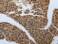 The image on the left is immunohistochemistry of paraffin-embedded Human liver cancer tissue using CSB-PA950035(SMAD7 Antibody) at dilution 1/60, on the right is treated with synthetic peptide. (Original magnification: ×200)
