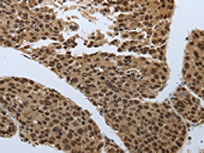 The image on the left is immunohistochemistry of paraffin-embedded Human liver cancer tissue using CSB-PA950035(SMAD7 Antibody) at dilution 1/60, on the right is treated with synthetic peptide. (Original magnification: ×200)