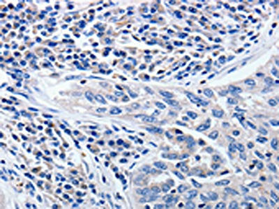 The image on the left is immunohistochemistry of paraffin-embedded Human lung cancer tissue using CSB-PA950095(CCNE1 Antibody) at dilution 1/5, on the right is treated with synthetic peptide. (Original magnification: ×200)