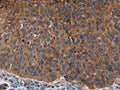 The image on the left is immunohistochemistry of paraffin-embedded Human lung cancer tissue using CSB-PA950440(JUP Antibody) at dilution 1/50, on the right is treated with fusion protein. (Original magnification: ×200)