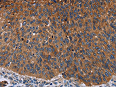 The image on the left is immunohistochemistry of paraffin-embedded Human lung cancer tissue using CSB-PA950440(JUP Antibody) at dilution 1/50, on the right is treated with fusion protein. (Original magnification: ×200)