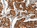 The image on the left is immunohistochemistry of paraffin-embedded Human breast cancer tissue using CSB-PA950500(AGO4 Antibody) at dilution 1/25, on the right is treated with synthetic peptide. (Original magnification: ×200)