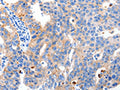 The image on the left is immunohistochemistry of paraffin-embedded Human breast cancer tissue using CSB-PA950615(MAPK10 Antibody) at dilution 1/10, on the right is treated with synthetic peptide. (Original magnification: ×200)