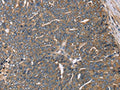 The image on the left is immunohistochemistry of paraffin-embedded Human cervical cancer tissue using CSB-PA950658(HSD17B12 Antibody) at dilution 1/30, on the right is treated with fusion protein. (Original magnification: ×200)