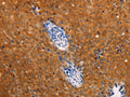 The image on the left is immunohistochemistry of paraffin-embedded Human cervical cancer tissue using CSB-PA951077(DCT Antibody) at dilution 1/25, on the right is treated with fusion protein. (Original magnification: ×200)