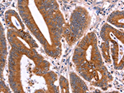 The image on the left is immunohistochemistry of paraffin-embedded Human colon cancer tissue using CSB-PA951162(CRISP3 Antibody) at dilution 1/40, on the right is treated with fusion protein. (Original magnification: ×200)
