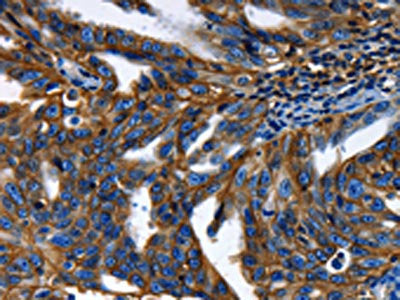 The image on the left is immunohistochemistry of paraffin-embedded Human ovarian cancer tissue using CSB-PA951195(ABCC5 Antibody) at dilution 1/50, on the right is treated with synthetic peptide. (Original magnification: X200)