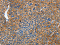 The image on the left is immunohistochemistry of paraffin-embedded Human liver cancer tissue using CSB-PA951577(AUP1 Antibody) at dilution 1/50, on the right is treated with fusion protein. (Original magnification: ×200)
