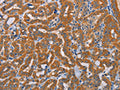 The image on the left is immunohistochemistry of paraffin-embedded Human thyroid cancer tissue using CSB-PA951869(ALDH3A1 Antibody) at dilution 1/30, on the right is treated with fusion protein. (Original magnification: ×200)