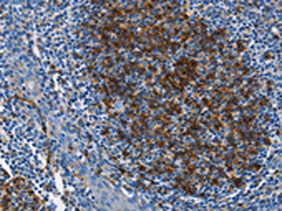 The image on the left is immunohistochemistry of paraffin-embedded Human tonsil tissue using CSB-PA951901(FCER2 Antibody) at dilution 1/40, on the right is treated with fusion protein. (Original magnification: ×200)