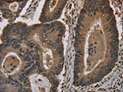 The image on the left is immunohistochemistry of paraffin-embedded Human colon cancer tissue using CSB-PA951904(HIST4H4 Antibody) at dilution 1/20, on the right is treated with fusion protein. (Original magnification: ×200)