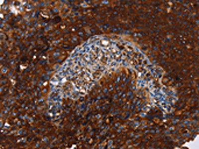 The image on the left is immunohistochemistry of paraffin-embedded Human cervical cancer tissue using CSB-PA952111(MSLN Antibody) at dilution 1/40, on the right is treated with fusion protein. (Original magnification: ×200)