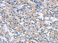 The image on the left is immunohistochemistry of paraffin-embedded Human thyroid cancer tissue using CSB-PA952204(PLEKHO1 Antibody) at dilution 1/40, on the right is treated with fusion protein. (Original magnification: ×200)