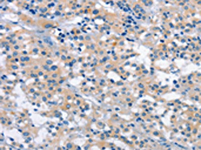 The image on the left is immunohistochemistry of paraffin-embedded Human thyroid cancer tissue using CSB-PA952204(PLEKHO1 Antibody) at dilution 1/40, on the right is treated with fusion protein. (Original magnification: ×200)