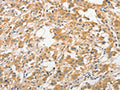 The image on the left is immunohistochemistry of paraffin-embedded Human thyroid cancer tissue using CSB-PA952266(ANAPC5 Antibody) at dilution 1/30, on the right is treated with fusion protein. (Original magnification: ×200)