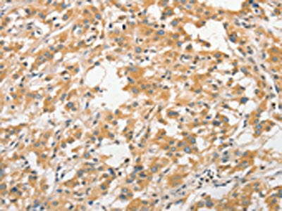 The image on the left is immunohistochemistry of paraffin-embedded Human thyroid cancer tissue using CSB-PA952266(ANAPC5 Antibody) at dilution 1/30, on the right is treated with fusion protein. (Original magnification: ×200)