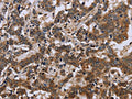 The image on the left is immunohistochemistry of paraffin-embedded Human liver cancer tissue using CSB-PA952632(FMR1 Antibody) at dilution 1/30, on the right is treated with fusion protein. (Original magnification: ×200)