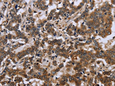 The image on the left is immunohistochemistry of paraffin-embedded Human liver cancer tissue using CSB-PA952632(FMR1 Antibody) at dilution 1/30, on the right is treated with fusion protein. (Original magnification: ×200)