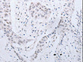The image on the left is immunohistochemistry of paraffin-embedded Human esophagus cancer tissue using CSB-PA952756(CCND2 Antibody) at dilution 1/20, on the right is treated with synthetic peptide. (Original magnification: ×200)
