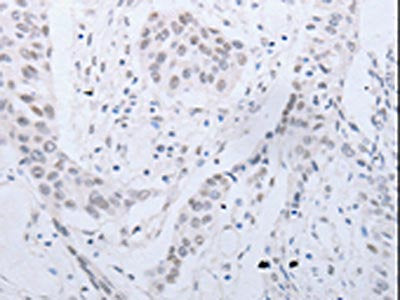 The image on the left is immunohistochemistry of paraffin-embedded Human esophagus cancer tissue using CSB-PA952756(CCND2 Antibody) at dilution 1/20, on the right is treated with synthetic peptide. (Original magnification: ×200)