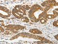 The image on the left is immunohistochemistry of paraffin-embedded Human colon cancer tissue using CSB-PA952925(PRPH Antibody) at dilution 1/15, on the right is treated with fusion protein. (Original magnification: ×200)
