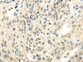 The image on the left is immunohistochemistry of paraffin-embedded Human breast cancer tissue using CSB-PA952927(CYP19A1 Antibody) at dilution 1/35, on the right is treated with synthetic peptide. (Original magnification: ×200)