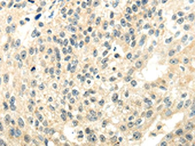 The image on the left is immunohistochemistry of paraffin-embedded Human breast cancer tissue using CSB-PA952927(CYP19A1 Antibody) at dilution 1/35, on the right is treated with synthetic peptide. (Original magnification: ×200)