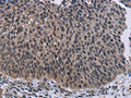 The image on the left is immunohistochemistry of paraffin-embedded Human lung cancer tissue using CSB-PA953461(KDM4D Antibody) at dilution 1/50, on the right is treated with fusion protein. (Original magnification: ×200)