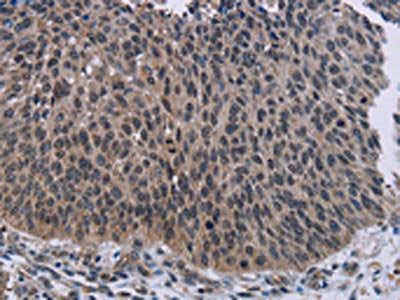 The image on the left is immunohistochemistry of paraffin-embedded Human lung cancer tissue using CSB-PA953461(KDM4D Antibody) at dilution 1/50, on the right is treated with fusion protein. (Original magnification: ×200)