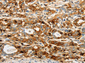 The image on the left is immunohistochemistry of paraffin-embedded Human gastic cancer tissue using CSB-PA953473(OASL Antibody) at dilution 1/20, on the right is treated with fusion protein. (Original magnification: ×200)