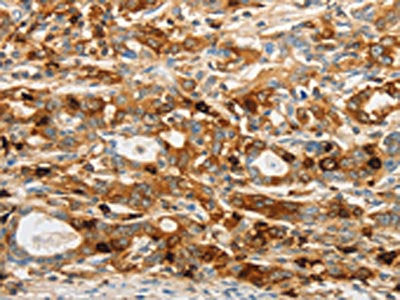 The image on the left is immunohistochemistry of paraffin-embedded Human gastic cancer tissue using CSB-PA953473(OASL Antibody) at dilution 1/20, on the right is treated with fusion protein. (Original magnification: ×200)