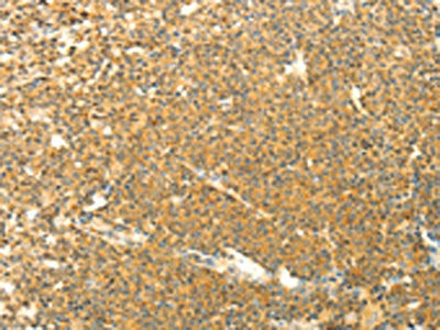 The image on the left is immunohistochemistry of paraffin-embedded Human lymphoma tissue using CSB-PA953606(AARS2 Antibody) at dilution 1/40, on the right is treated with fusion protein. (Original magnification: ×200)