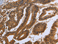 The image on the left is immunohistochemistry of paraffin-embedded Human colon cancer tissue using CSB-PA953662(DUSP8 Antibody) at dilution 1/30, on the right is treated with synthetic peptide. (Original magnification: ×200)