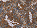 The image on the left is immunohistochemistry of paraffin-embedded Human colon cancer tissue using CSB-PA953889(IL27RA Antibody) at dilution 1/40, on the right is treated with fusion protein. (Original magnification: ×200)