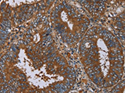 The image on the left is immunohistochemistry of paraffin-embedded Human colon cancer tissue using CSB-PA953889(IL27RA Antibody) at dilution 1/40, on the right is treated with fusion protein. (Original magnification: ×200)