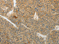 The image on the left is immunohistochemistry of paraffin-embedded Human liver cancer tissue using CSB-PA954118(TEKT5 Antibody) at dilution 1/40, on the right is treated with fusion protein. (Original magnification: ×200)