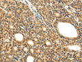 The image on the left is immunohistochemistry of paraffin-embedded Human thyroid cancer tissue using CSB-PA954164(LYZ Antibody) at dilution 1/20, on the right is treated with fusion protein. (Original magnification: ×200)