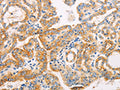 The image on the left is immunohistochemistry of paraffin-embedded Human thyroid cancer tissue using CSB-PA954231(SUFU Antibody) at dilution 1/10, on the right is treated with fusion protein. (Original magnification: ×200)