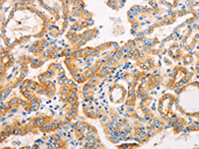 The image on the left is immunohistochemistry of paraffin-embedded Human thyroid cancer tissue using CSB-PA954231(SUFU Antibody) at dilution 1/10, on the right is treated with fusion protein. (Original magnification: ×200)
