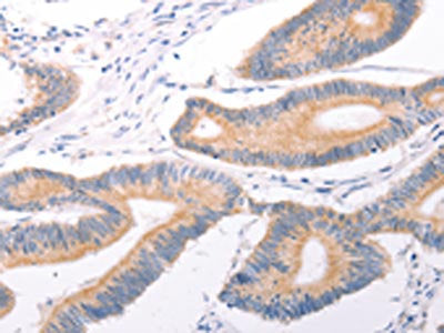 The image on the left is immunohistochemistry of paraffin-embedded Human colon cancer tissue using CSB-PA954426(TRPC7 Antibody) at dilution 1/25, on the right is treated with fusion protein. (Original magnification: ×200)