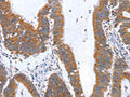 The image on the left is immunohistochemistry of paraffin-embedded Human colon cancer tissue using CSB-PA954619(TNF Antibody) at dilution 1/35, on the right is treated with fusion protein. (Original magnification: ×200)