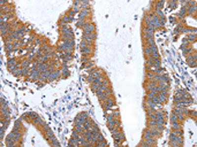 The image on the left is immunohistochemistry of paraffin-embedded Human colon cancer tissue using CSB-PA954619(TNF Antibody) at dilution 1/35, on the right is treated with fusion protein. (Original magnification: ×200)