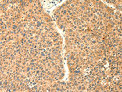 The image on the left is immunohistochemistry of paraffin-embedded Human liver cancer tissue using CSB-PA954966(TRAF6 Antibody) at dilution 1/20, on the right is treated with fusion protein. (Original magnification: ×200)