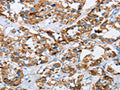 The image on the left is immunohistochemistry of paraffin-embedded Human thyroid cancer tissue using CSB-PA955413(HINT2 Antibody) at dilution 1/40, on the right is treated with fusion protein. (Original magnification: ×200)