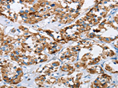 The image on the left is immunohistochemistry of paraffin-embedded Human thyroid cancer tissue using CSB-PA955413(HINT2 Antibody) at dilution 1/40, on the right is treated with fusion protein. (Original magnification: ×200)