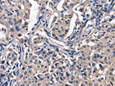 The image on the left is immunohistochemistry of paraffin-embedded Human lung cancer tissue using CSB-PA955522(PEBP1 Antibody) at dilution 1/50, on the right is treated with fusion protein. (Original magnification: ×200)