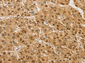 The image on the left is immunohistochemistry of paraffin-embedded Human liver cancer tissue using CSB-PA955584(PSMB7 Antibody) at dilution 1/20, on the right is treated with fusion protein. (Original magnification: ×200)