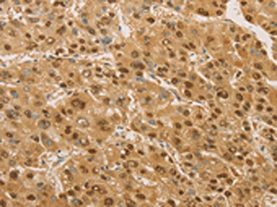 The image on the left is immunohistochemistry of paraffin-embedded Human liver cancer tissue using CSB-PA955584(PSMB7 Antibody) at dilution 1/20, on the right is treated with fusion protein. (Original magnification: ×200)